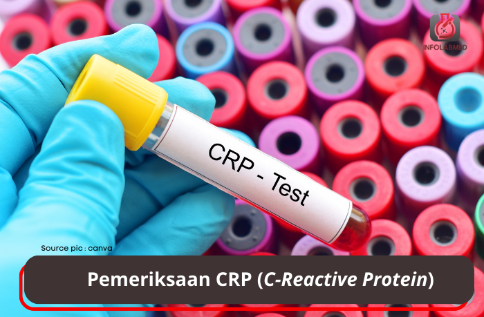 Pemeriksaan CRP (C-Reactive Protein)
