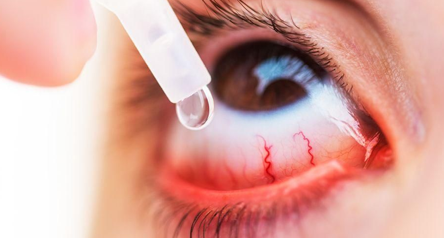 10 Sebab Kenapa Mata Merah Tapi Tidak Sakit