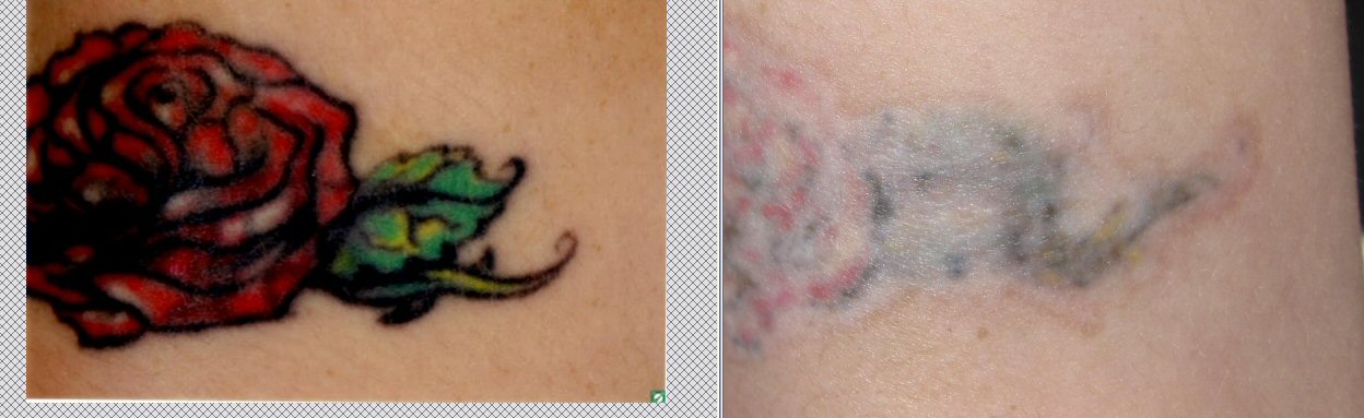 Chronicles of a Tattoo Removal
