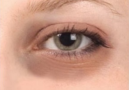 Tips mengurangi lingkaran hitam pada mata