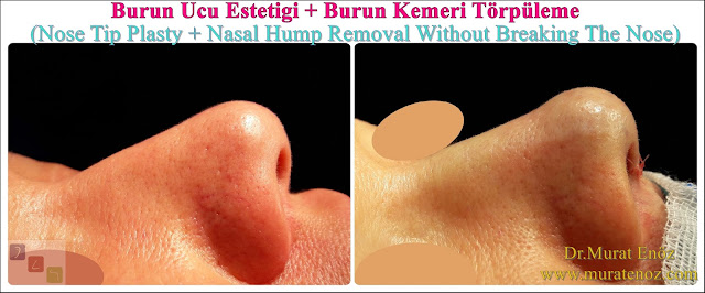 Rhinoplasty Without Breaking Nasal Bone - Rhinoplasty Without Breaking Nasal Bone - Female Nose Aesthetic Surgery - Nose Jobs For Women - Nose Reshaping for Women - Female Rhinoplasty Istanbul - Nose Job Surgery for Women - Women's Rhinoplasty - Nose Aesthetic Surgery For Women - Female Rhinoplasty Surgery in Istanbul - Female Rhinoplasty Surgery in Turkey