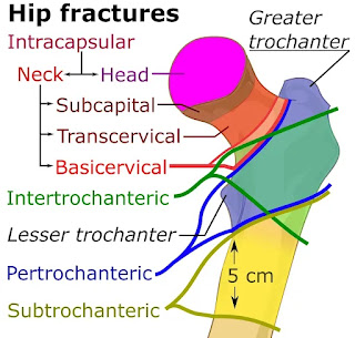What is Hip Fracture