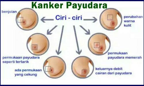 Kanker payudara tidak sakit, operasi kanker payudara stadium 2, obat ampuh atasi kanker payudara, kanker payudara tanda tandanya, pengobatan untuk kanker payudara, kanker payudara hormonal, kanker payudara klikdokter, perbedaan kanker payudara jinak dan ganas, kanker payudara menyebar ke otak, bahaya kanker payudara pada pria, resep obat herbal kanker payudara