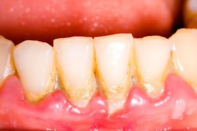 Nguyên nhân nướu răng bị chảy máu