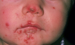 blisters of honey coloured around the mouth and nose disease pictures