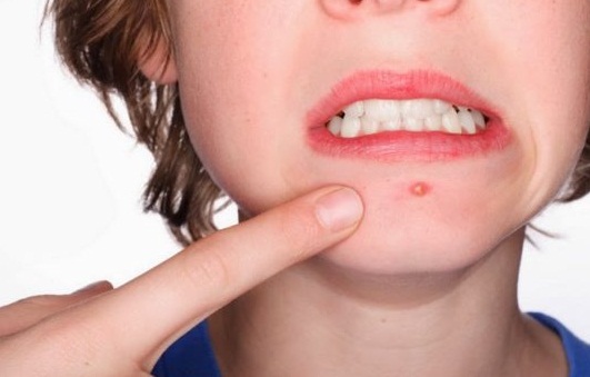 How to Get Rid of Cystic Acne