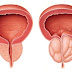 BPH ICD 9 Code with Obstruction