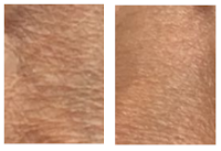 Microneedling skin  structure improvement