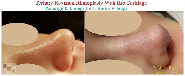 Revision nose aesthetic surgery - Revision nose job in Istanbul - Tertiary nose job in Turkey - - Tertiary rhinoplasty - Tertiary rhinoplasty challenges - Revision rhinoplasty using rib cartilage - Cost of Revision Rhinoplasty in Istanbul - Healing After Revision Rhinoplasty Operation - Revision Rhinoplasty in Istanbul -  Tertiary rhinoplasty using rib cartilage in Istanbul Turkey