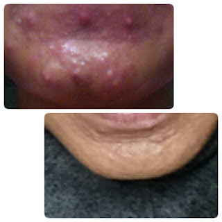 acne story 