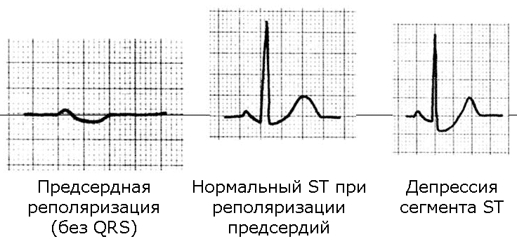 Реполяризации диффузного характера