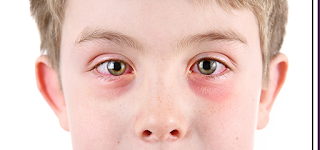 Conjuntivitis Alérgica