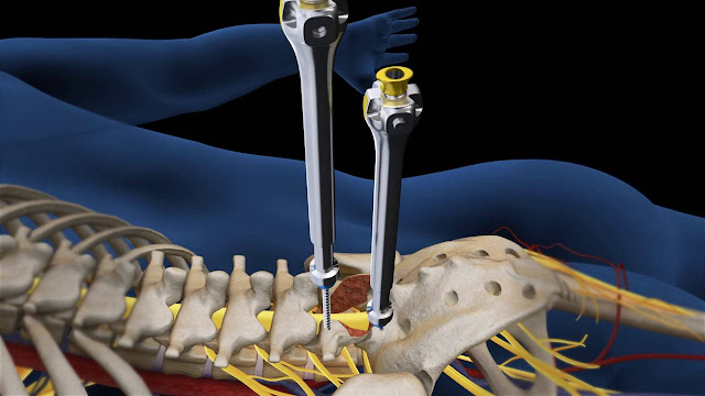 lumbar spinal fusion