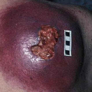 Skin cancer images