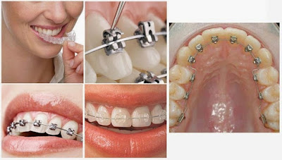 Phương pháp niềng răng mặt trong bao nhiêu?