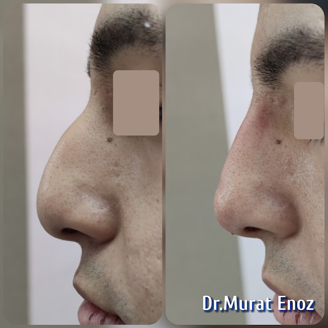 limited filler injection to the nose,Non surgical nose job with filler,