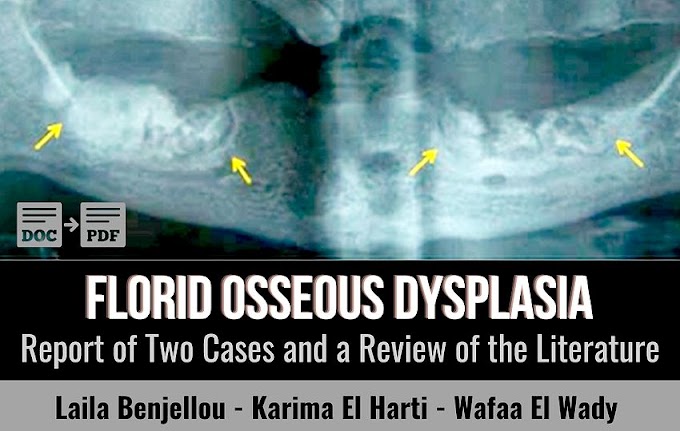 PDF: Florid Osseous Dysplasia: Report of Two Cases and a Review of the Literature