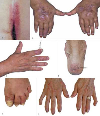 The Common Types of Arthritis in Fingers Psoriatic arthritis is a specific 
