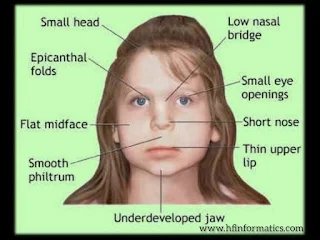 Fetal Alcohol Syndrome Face Adults, Symptoms, Causes: