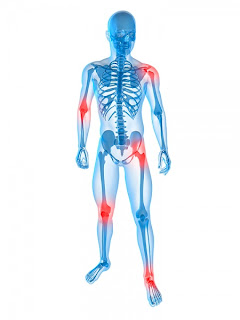 sintomas artritis reumatoide