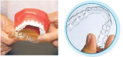Quy trình niềng răng bằng máng