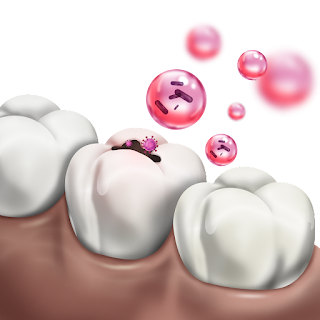 Periodontitis