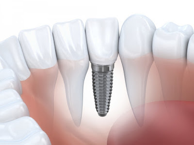  Cấu tạo của răng Implant nha khoa