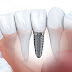  Cấu tạo của răng Implant nha khoa