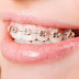  Niềng răng xong vẫn hô do nguyên nhân nào