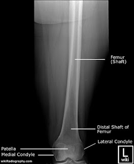 TEKNIK RADIOGRAFI FEMUR