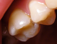 Black Hole In Tooth2