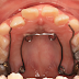 Niềng răng không nhổ răng với nong xương hàm