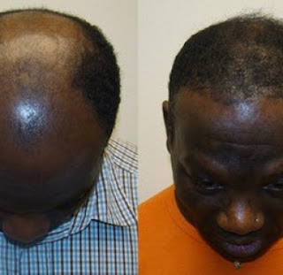 Man regrows is bald hair, gossip, human hair , techniques,