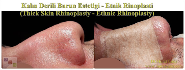 Kalın derili burun estetiği algoritması - Kalın derili rinoplasti - Thick skin rhinoplasty in İstanbul - Kalın derili burun estetiği teknikleri - Kalın derili burun estetiği nasıl yapılır? - Kalın derili burun estetiği en iyi teknik hangisidir? - Rhinoplasty in İstanbul - Thick skin nose job - Etnik burun estetiği - Ethnic rhinoplasty - Ethnic nose job in İstanbul, Turkey