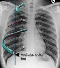 chest xray inspiration