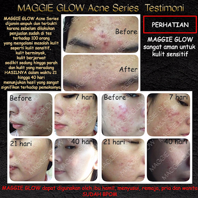 harga maggie glow acne 5 in 1 complete series bpom asli