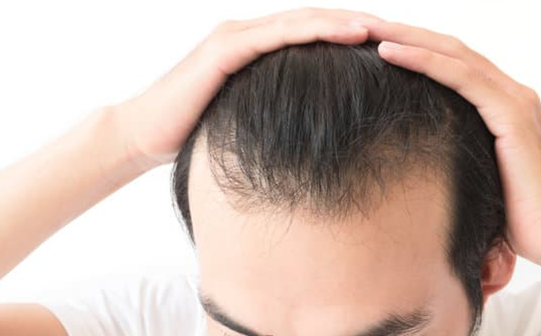 7 Causes of Hair Loss in Men in 2020