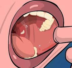 preventing Tonsil stones