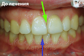 Смещение центр  верхних зубов