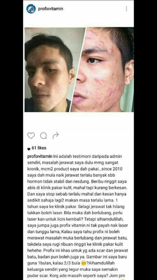 ProFix Vitamin Muka Berlubang: Qalish Profix Testimoni 