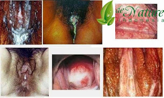 Obat Vagina Mengeluarkan Nanah Dan Perih