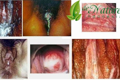 Obat Vagina Mengeluarkan Nanah Dan Perih