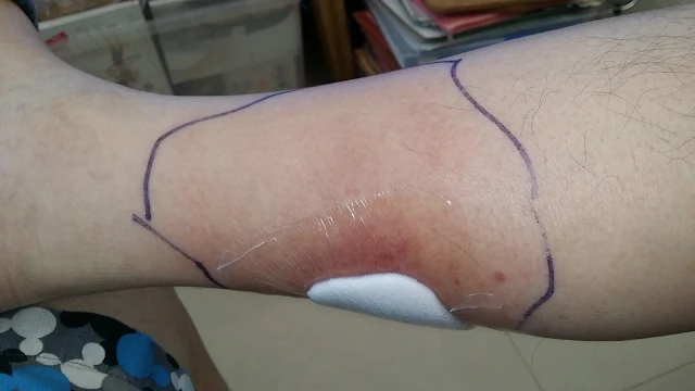 Cellulitis wound is fading