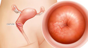 What is Cervical Cancer?