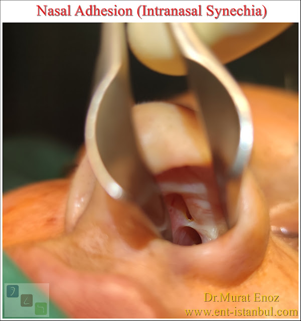 Intranasal Synechia,Nasal Adhesion,