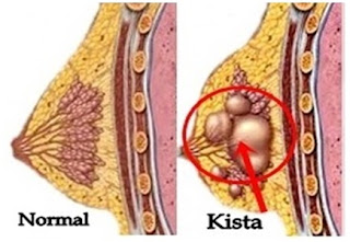 Penyebab dan Gejala Kista Payudara