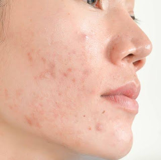 Here are some quick and easy remedies to get rid of acne scars and blemishes forever. pimple