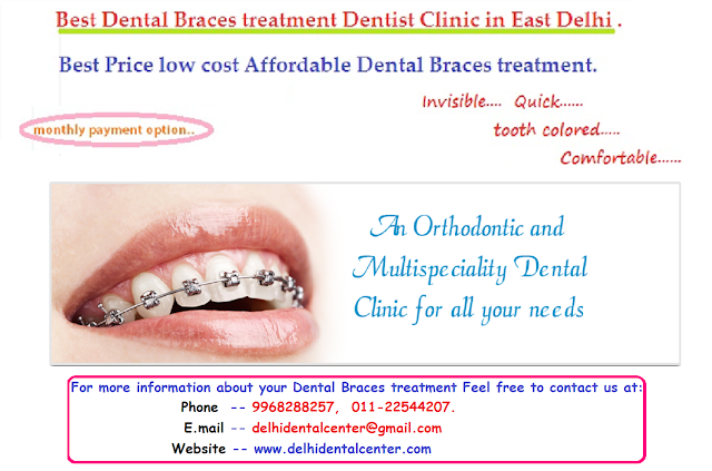 Dental Braces clinic Delhi, Dental Braces Delhi, orthodontist Delhi, Dental Braces in Delhi, Braces Dentist in Delhi, Braces Delhi, Braces Clinic in Delhi, Dental Braces Treatment in Delhi.