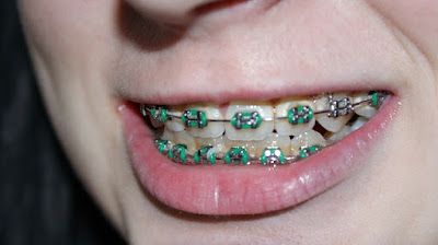 Stop! Dangers of Wearing Braces for Dental and Oral Health