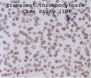 Case Study (10)- Transient thrombocytosis